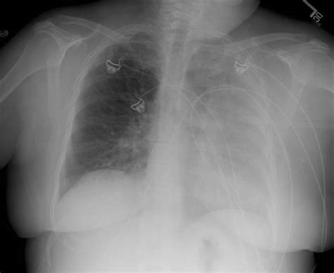 case  progressive dyspnea  abnormal chest  ray  case