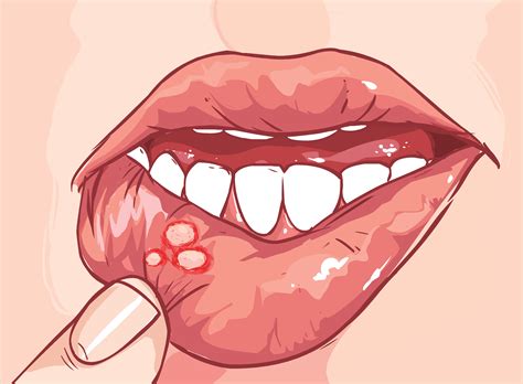 What Is An Aphthous Ulcer Canker Sore And How Are They