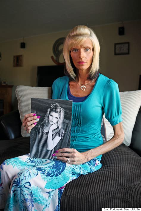 former model starving to death due to rare medical condition superior mesenteric artery syndrome