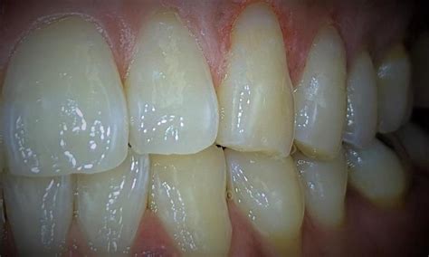 smile gallery garland grove dentistry real patient results