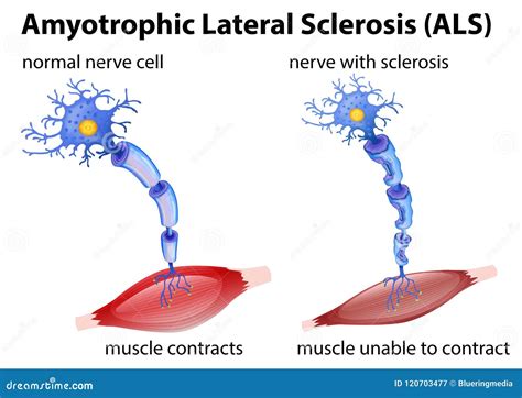 amyotrophic lateral sclerosis concept stock vector illustration  isolated amyotrophic