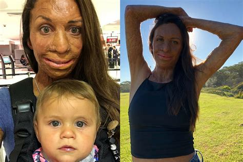Turia Pitt Doesn T Want You To Call Her A Victim That S Life Magazine
