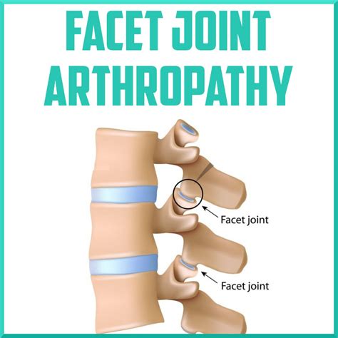 facet joint arthropathy sports medicine review