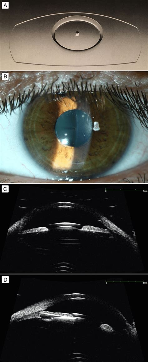 A Posterior Chamber Collamer Phakic Intraocular Lens Rsk