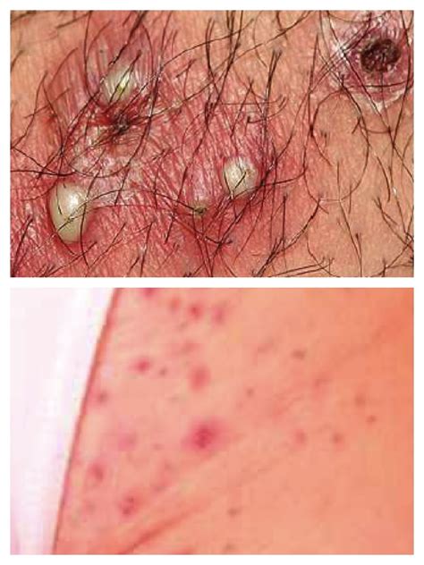 Folliculitis Causes And 21 Treatment Tips Brochures And Video