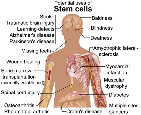 Treating Brain Injuries With Stem Cell Transplants