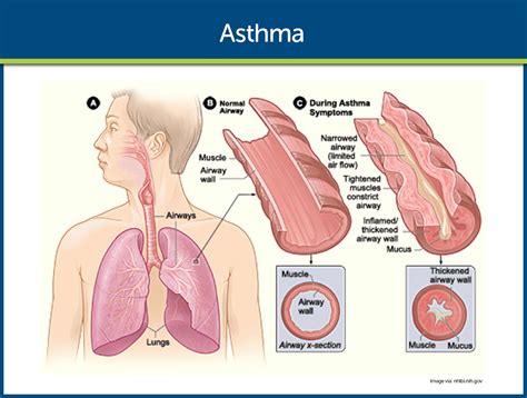 asthma nursing care management  study guide