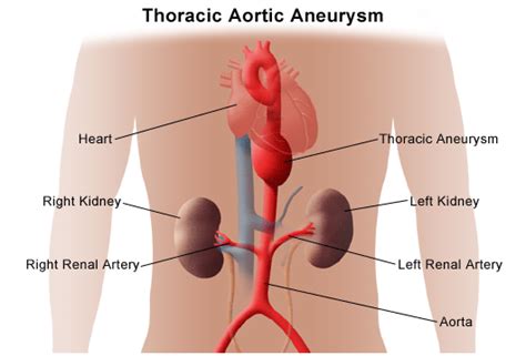 thoracic aortic aneurysm  aortic dissection stanford medicine
