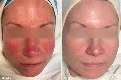 face photo gallery redness rosacea face beauty science