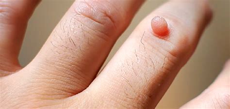 best treatment for warts in bangalore dr joshy s medical
