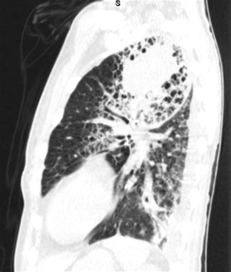 Ct Chest Showing The Left Upper Lobe Consolidation In A Lateral