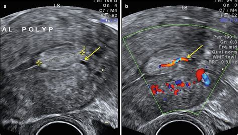 Ultrasound Evaluation Of Endometrium Obgyn Key