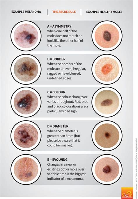 Guide In Detecting Signs Of Skin Cancer R Coolguides