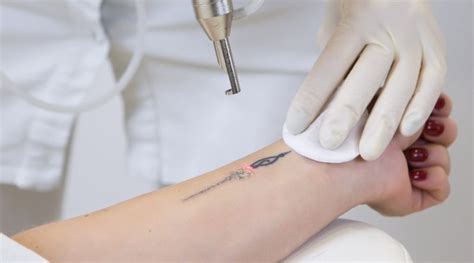 ways   care   skin   laser tattoo removal  enhanced