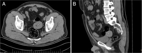 giant peritoneal loose body in the pelvic cavity confirmed by
