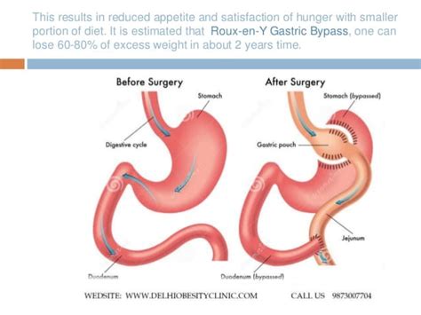 Roux En Y Gastric Surgery Bypass In Delhi