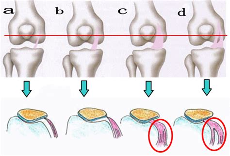 タナ障害（屈伸で膝がばきっと音がして痛い！ ） 古東整形外科・リウマチ科