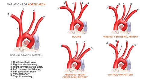 anatomical variations branching patterns   aortic arch