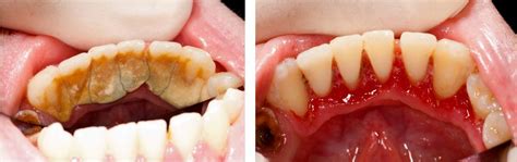 periodontitis  treatment matters   life