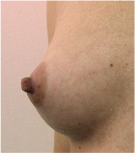 aroused inverted nipples