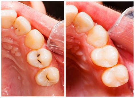 dental cavity myths lakefront family dentistry