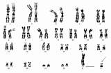 Fragile Karyotype Chromosome Patient Stain Inversion Chromo Abo Ing sketch template