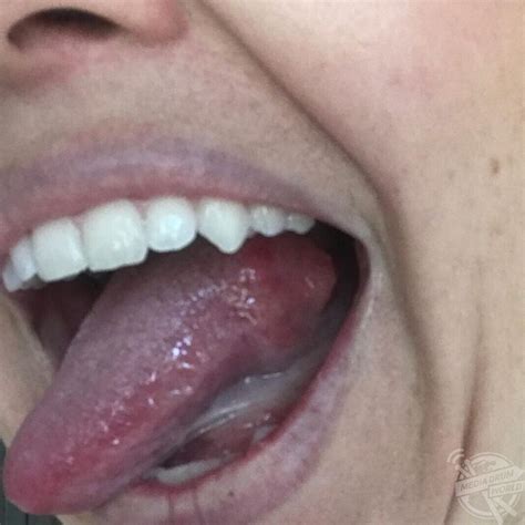 mum   shock   bump   tongue ended   cancer