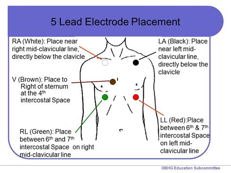 lead ecg placement diagram