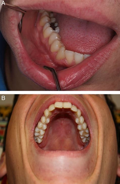 oral manifestations of crohn s disease bmj case reports