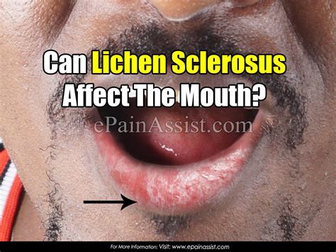 can lichen sclerosus affect the mouth