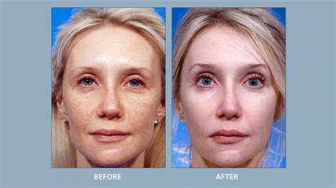 facial implants before and after facial cosmetic surgery michigan