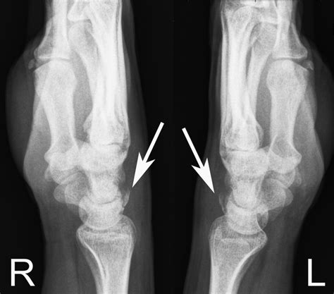 simultaneous bilateral fracture   triquetral bone bmj case reports