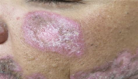 pink plaques   face journal   dermatology nurses association