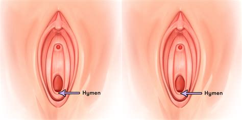 how do you know if your hymen is broken alqurumresort