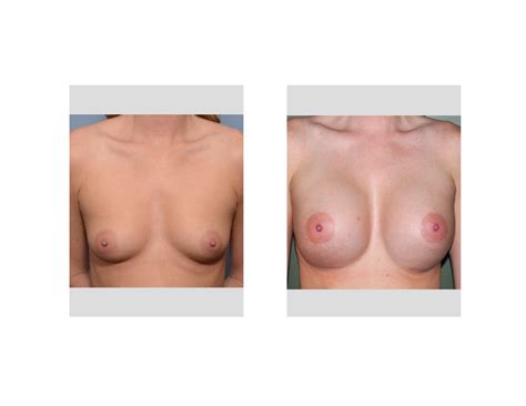natural breast enlargement enhancement porno photo