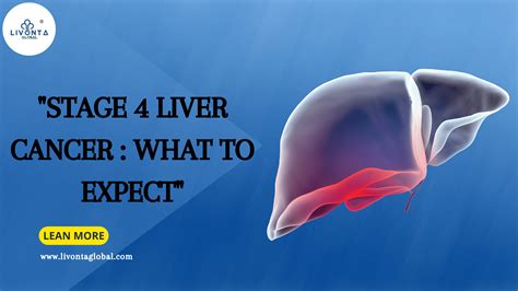 stage  liver cancer   expect livonta global pvt