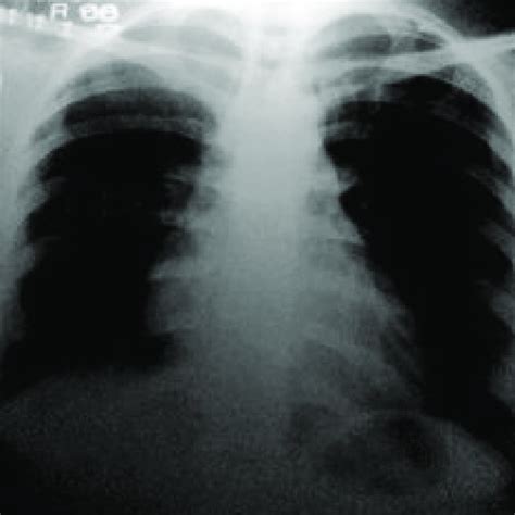 Chest X Ray Before Operation Showing Right Hilar Mass Red Arrow Mark