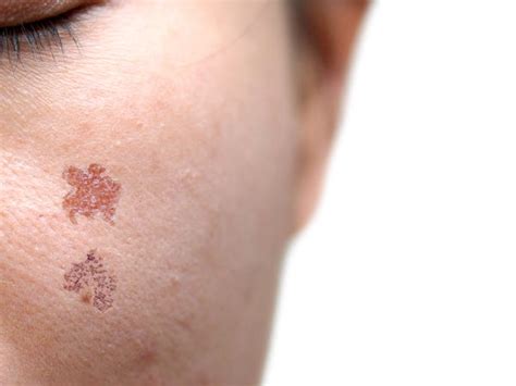 weird signs of skin cancer that are super hard to spot