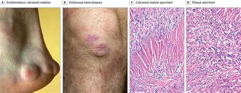 cutaneous nodules and erythematous plaques on the extremities