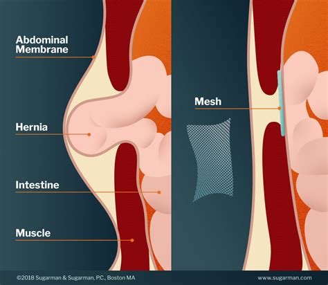 hernia mesh failures  injuries sugarman