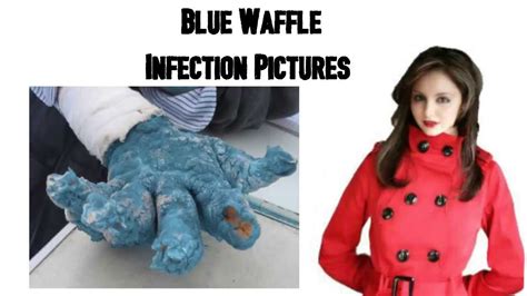Blue Waffle Infection Pictures Youtube