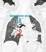 Bronchus Tracheal Radiology Radiopaedia Annotation sketch template