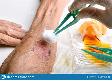 wound dressing doctor cleaning  wash infected wound  chronic