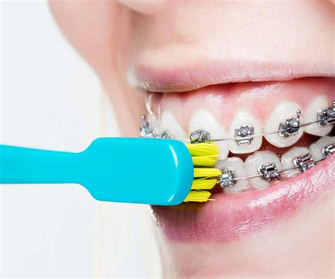 cleaning  teeth  braces specialist orthodontics treatment