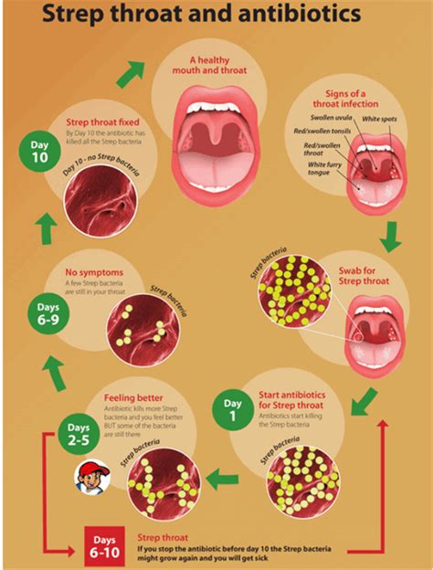strep throat vs viral infection gue viral