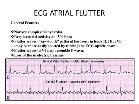 aflutter vs afib atrial flutter litfl ecg library diagnosis the two