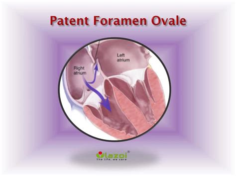patent foramen ovale  symptoms daignosis prevention  treatment powerpoint