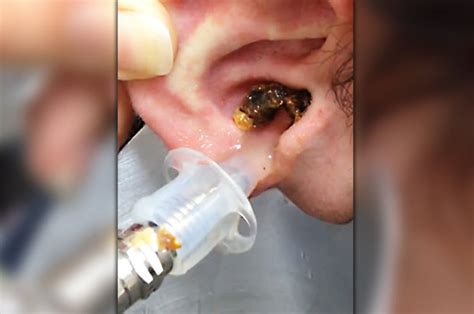 ear wax pours from man s ear after he has it syringed on camera daily