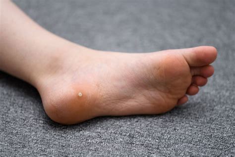 plantar wart removal and treatment moore foot and ankle specialists