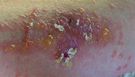 What To Do For Severe Poison Ivy Rash